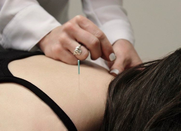 Trigger Point Dry Needling